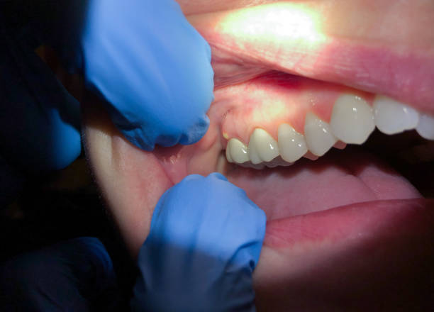 Best Emergency Tooth Extraction in Dubuque, IA